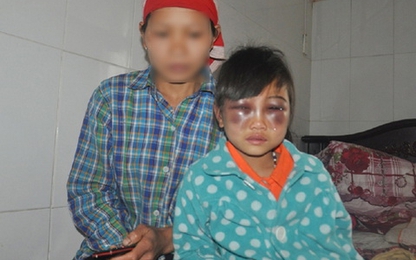 Lào Cai:Công an vào cuộc vụ bé gái bị cô giáo đánh tím mặt