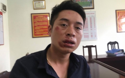Hà Nội: Tẩu thoát bất thành, người vi phạm đấm gãy răng CSGT