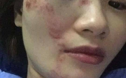 4 thanh niên đánh nữ nhân viên phụ xe buýt nhập viện