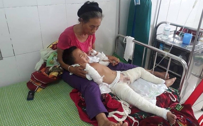 Nghệ An: Nghịch xăng, bé 4 tuổi cháy xém từ bụng đến chân