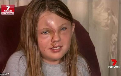 Bé gái bất ngờ bị hủy hoại gương mặt sau tai nạn thảm khốc