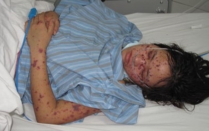 Bộ Y tế chỉ đạo khẩn phòng chống dịch viêm màng não mô cầu