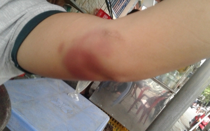 Đà Nẵng: Người dân “tố” công an còng tay, nhét roi điện vào miệng