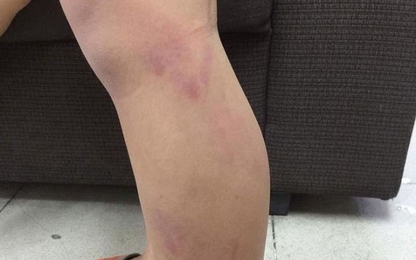 Học sinh lớp 2 bị cô giáo đánh tím hai chân vì vào lớp muộn