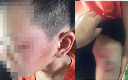 Bé trai 12 tuổi tố bị mẹ kế bạo hành phải nhập viện